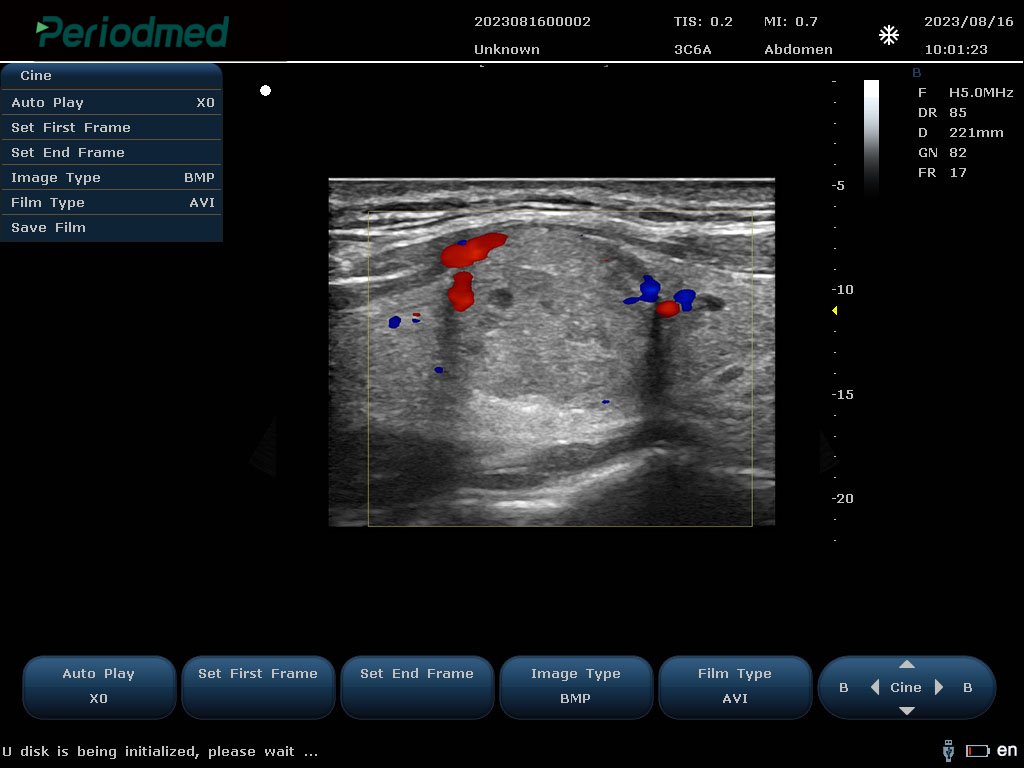 线阵探头-彩色多普勒模式-甲状腺 Linear Probe-Color Mode-THyroid3