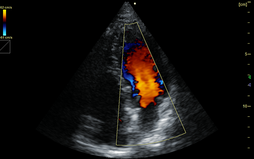 Cardiac CF Imaging