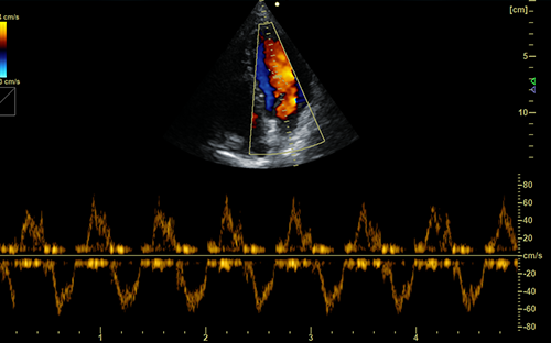 Cardiac CF+PW Imaging
