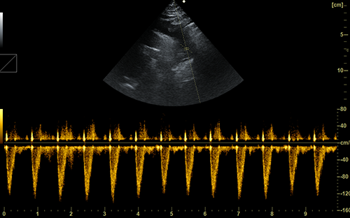 Cardiac PW Imaging