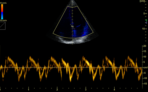 Cardiac TDI+PW Imaging