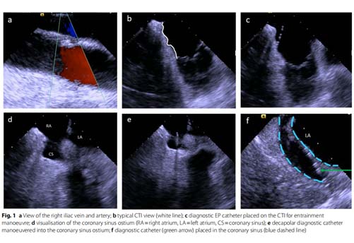 Catheter navigation by intracardiac  echocardiography enables zero-fuoroscopy  linear lesion formation and bidirectional  cavotricuspid isthmus block in patients  with typical atrial futter