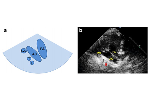 Study on the views and methods of ultrasonic screening and diagnosis for abnormal aortic arch in infants