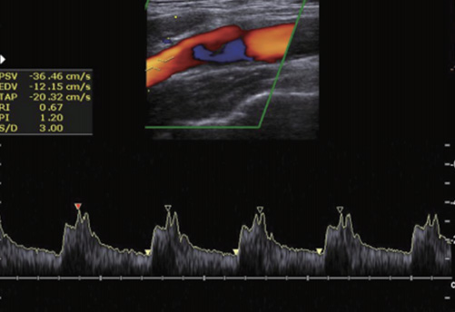 General principles of carotid Doppler  ultrasonography