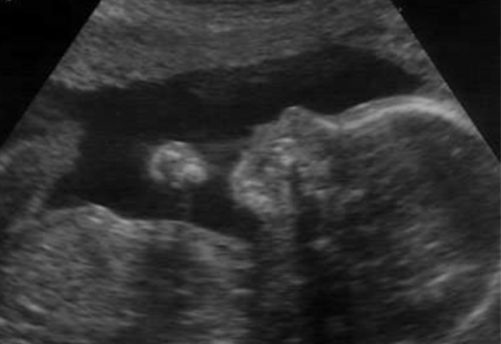 Fetal nasal bone length: reference range and clinical application in ultrasound screening for trisomy 21