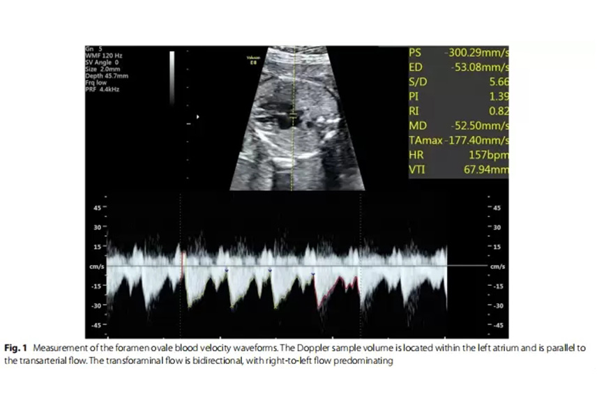 Evaluation of fetal foramen ovale blood fow  by pulsed Doppler ultrasonography combined  with spatiotemporal image correlation