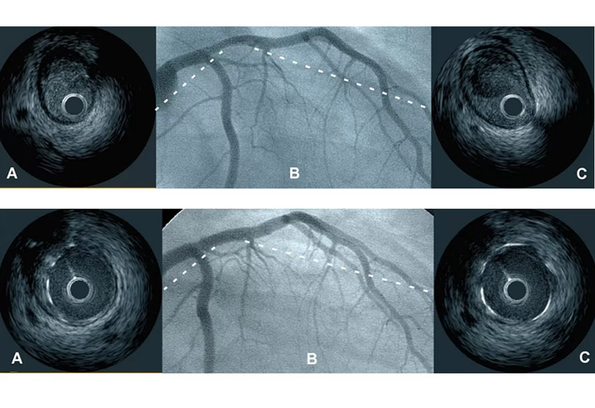 Intravascular ultrasound to guide the management of intracoronary  thrombus: a Case Report