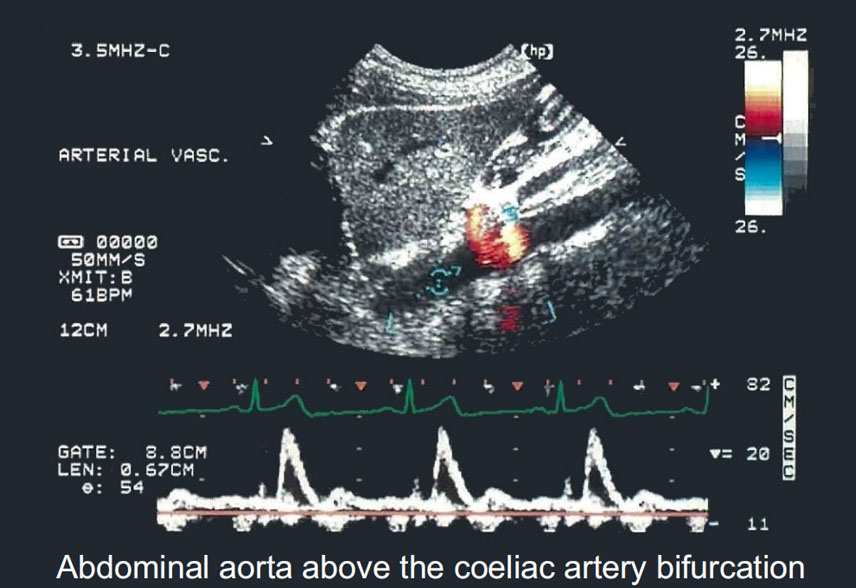 Physiological aspects of the determination of comprehensive arterial inflows in the lower abdomen assessed by Doppler ultrasound