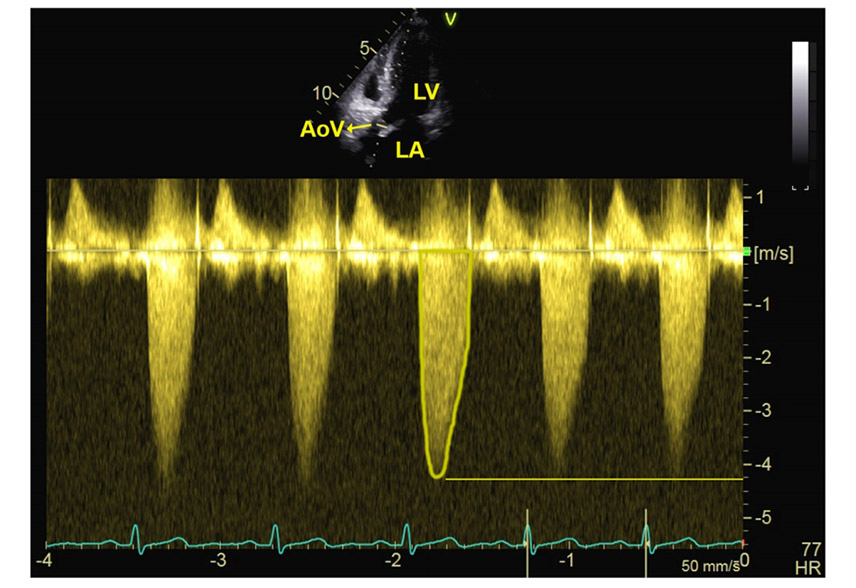 Vaginal delivery in a patient with severe aortic stenosis under epidural analgesia, a case report