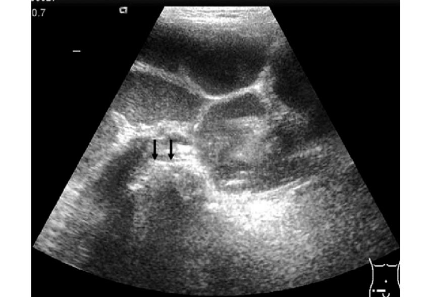 Intestinal Obstruction Caused by Potato Bezoar in Infancy: A Report of Three Cases