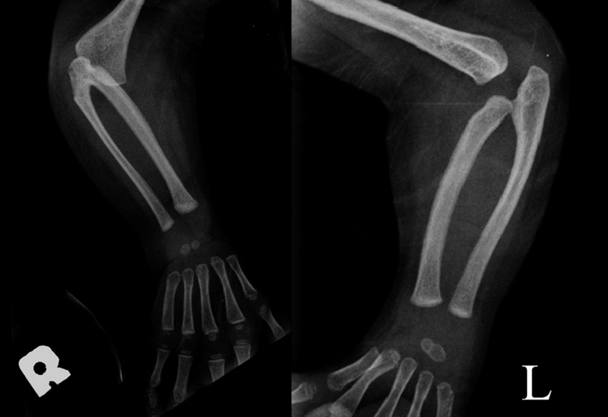 Nager Syndrome: A Case Report