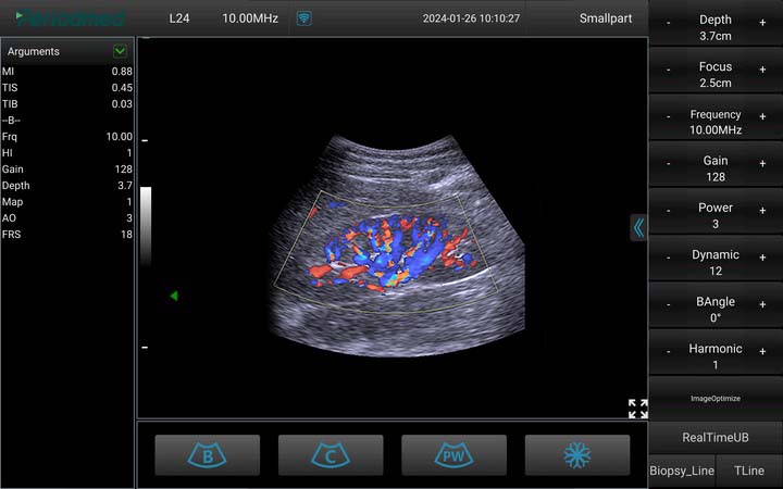 凸阵探头-彩色多普勒模式-肾脏 Convex Probe-Color Mode-Kidney 1