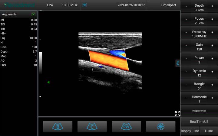 线阵探头-彩色多普勒模式-颈动脉 Linear Probe-Color Mode-Carotid3