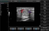 线阵探头-彩色多普勒模式-甲状腺 Linear Probe-Color Mode-THyroid3