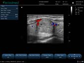 线阵探头-彩色多普勒模式-甲状腺 Linear Probe-Color Mode-THyroid3