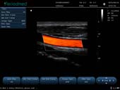 线阵探头-彩色多普勒模式-颈动脉 Linear Probe-Color Mode-Carotid3