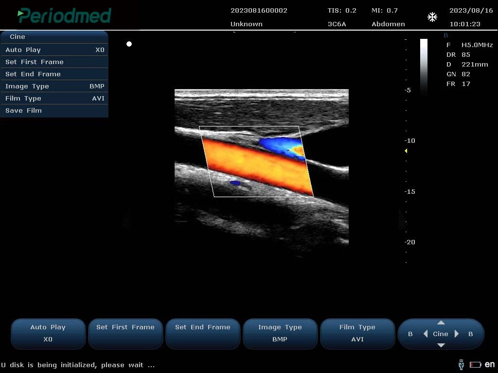 线阵探头-彩色多普勒模式-颈动脉 Linear Probe-Color Mode-Carotid2