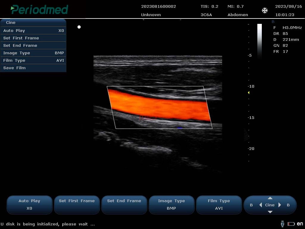 线阵探头-彩色多普勒模式-颈动脉 Linear Probe-Color Mode-Carotid3