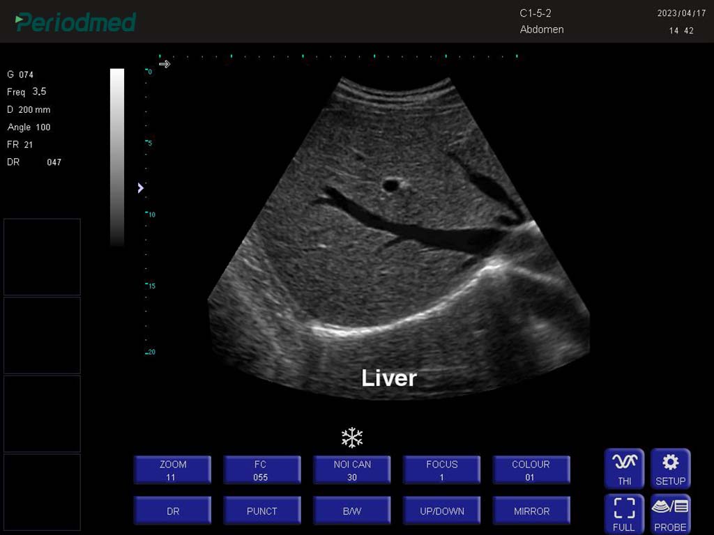 凸阵探头-B模式-肝脏 Convex Probe-B Mode-Liver3