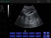 凸阵探头-B Mode-胆囊 Convex Probe-B Mode-Gallbladder1