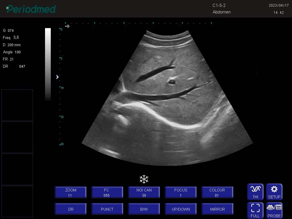 凸阵探头-B模式-肝脏 Convex Probe-B Mode-Liver5