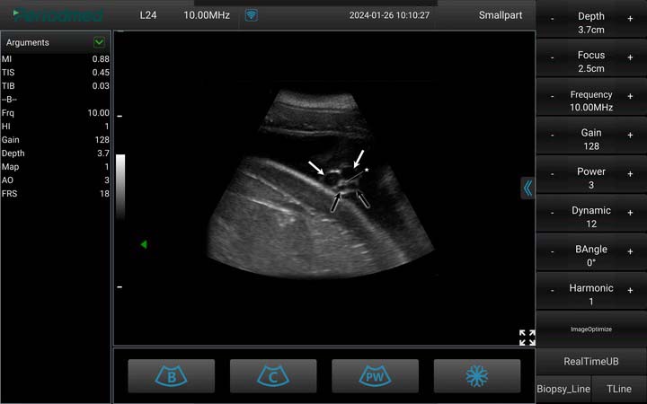 海豚- 凸阵-B模式-子宫 Convex Probe-B Mode-Uterus2 Dolphin