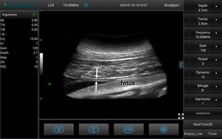 海豚-凸阵-B模式-子宫 Convex Probe-B Mode-Uterus  Dolphin