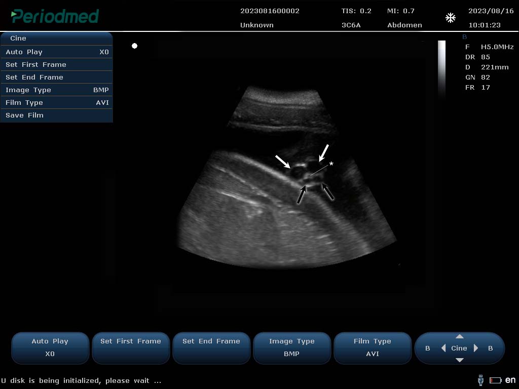 海豚- 凸阵-B模式-子宫 Convex Probe-B Mode-Uterus2 Dolphin