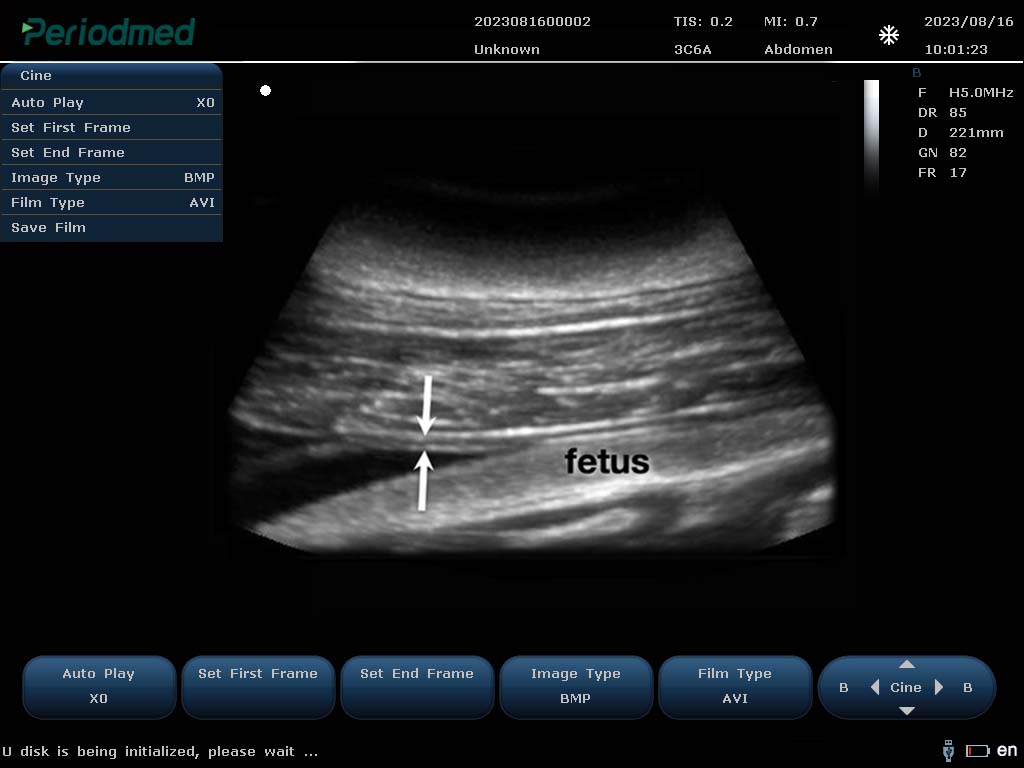 海豚-凸阵-B模式-子宫 Convex Probe-B Mode-Uterus  Dolphin