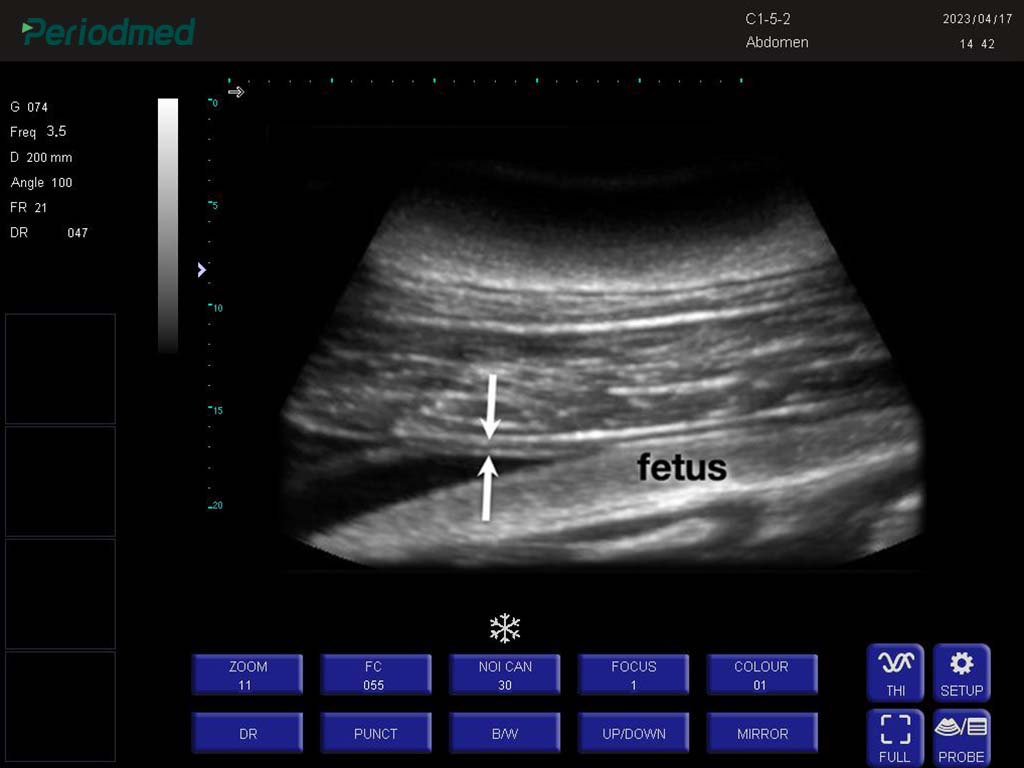 海豚-凸阵-B模式-子宫 Convex Probe-B Mode-Uterus Dolphin