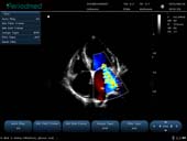 相控阵探头-彩色多普勒模式-心脏 Phased Array Probe-Color Mode-Cardiac1