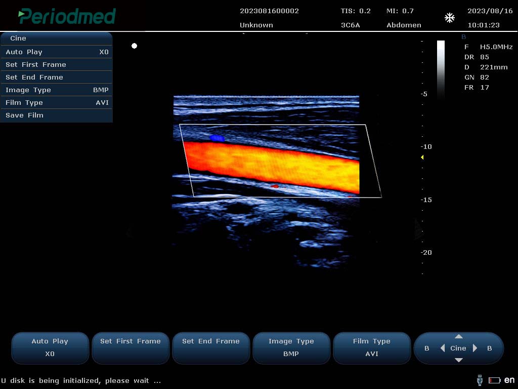 线阵探头-彩色多普勒模式-颈动脉 Linear Probe-Color Mode-Carotid1