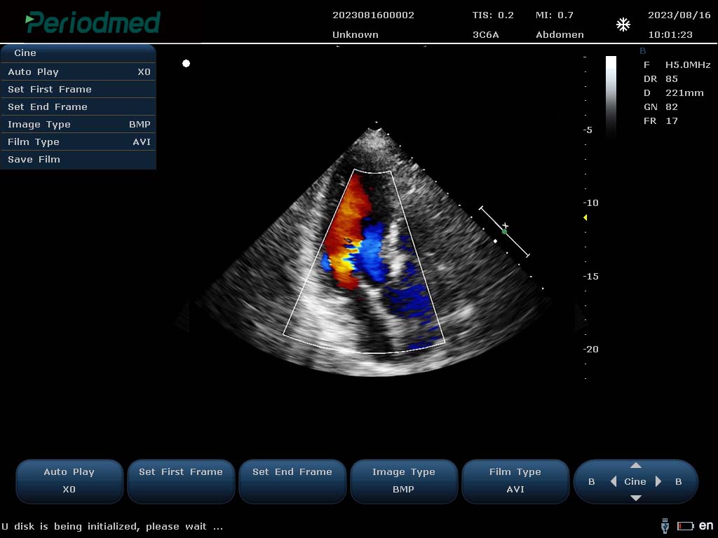 相控阵探头-彩色多普勒模式-心脏 Phased Array Probe-Color Mode-Cardiac3