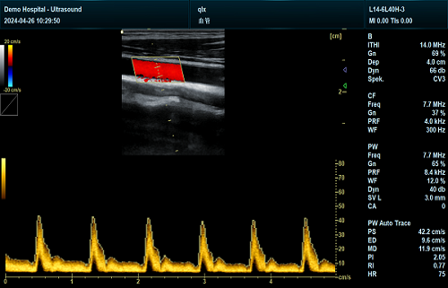 Carotid B+CF+PW