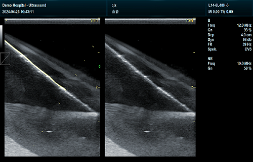 Needle enhancement