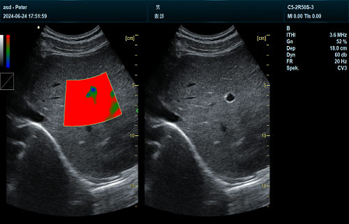 Elastography