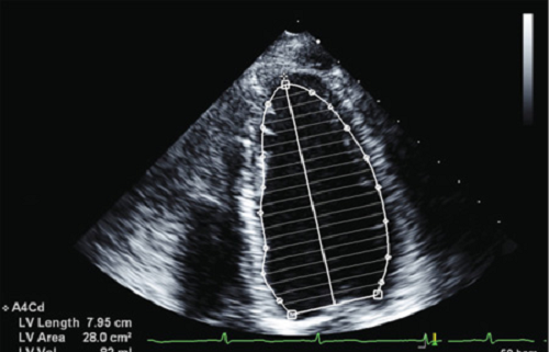 Heart ultrasound