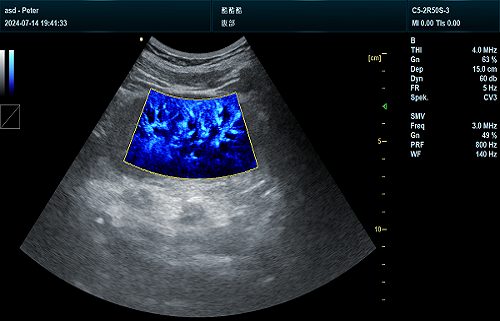 Convex+Kidney+SMV mode(Blue)