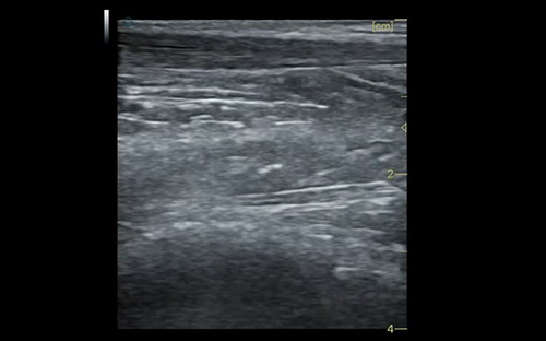 Achilles tendon 跟腱