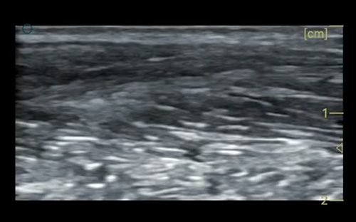 Patellar ligament 髌韧带