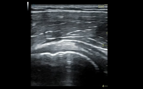 Coracohumeral ligament 喙肱韧带