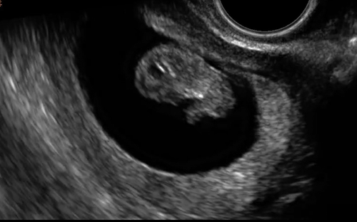 孕囊-1Fertilized egg
