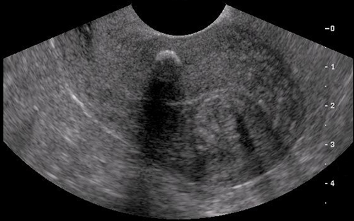 子宫-1Uterus