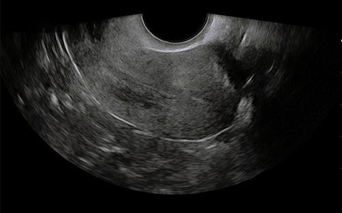子宫Uterus