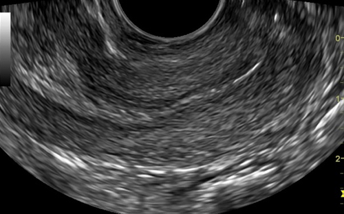 子宫内膜Endometrium