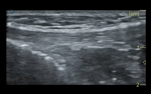 Calcaneofibular ligament 跟腓韧带