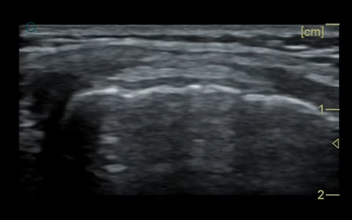 Collateral ligament 侧副韧带